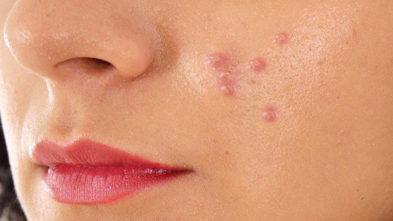 Pimples-SideEffects